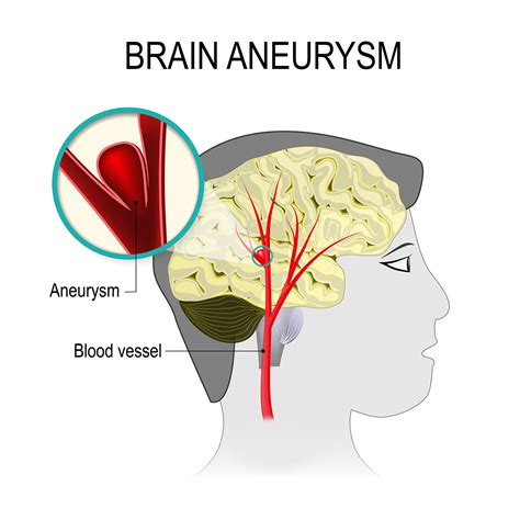 brain aneurysm cause